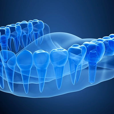 result-jaw-bone-loss-dentures
