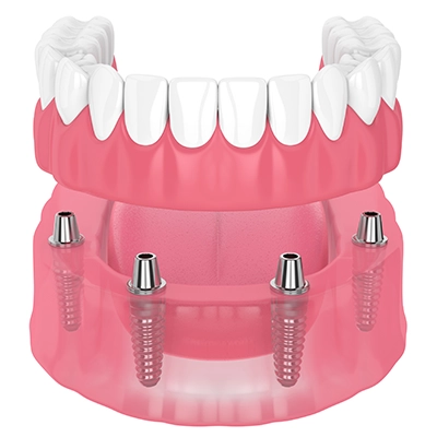 dental-implants-for-dentures-model