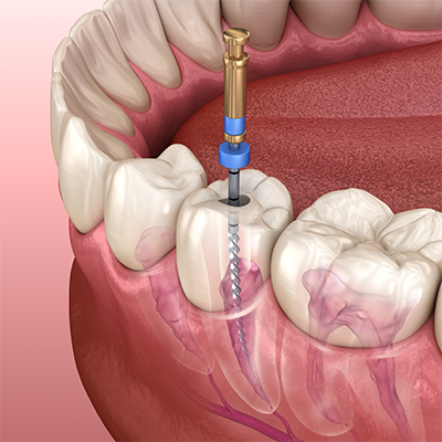 Photo shows dental tooth root canal dentists teeth model closeup.