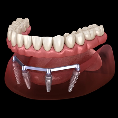 all on 4 dental implants vs other dental implants