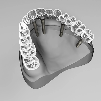 all on 4 dental implant procedure