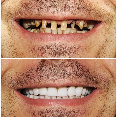 Before and after all on 4 dental implants
