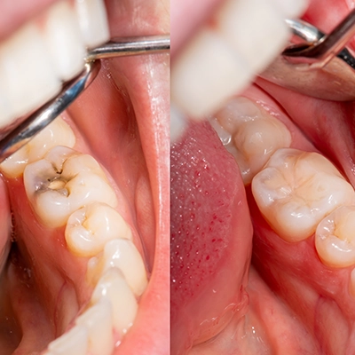tooth filling procedure