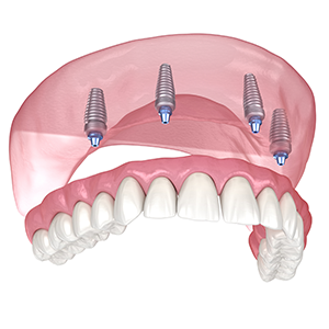 Denture implant
