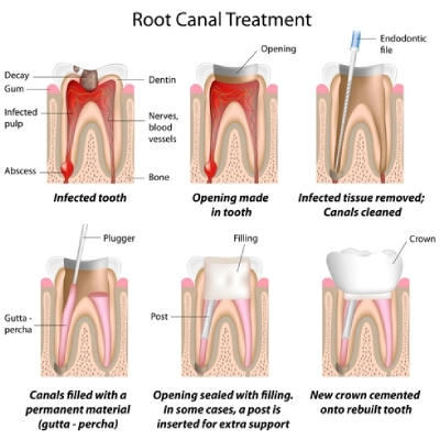 working of root canal treatment
