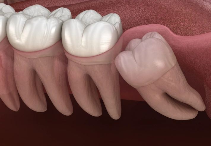 Is Wisdom Teeth Removal Painful?