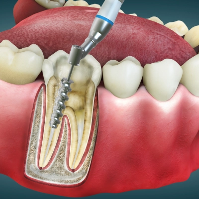 Root Canal Treatment Services by Dr. Craig Baker