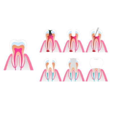 Signs and Symptoms of root canal