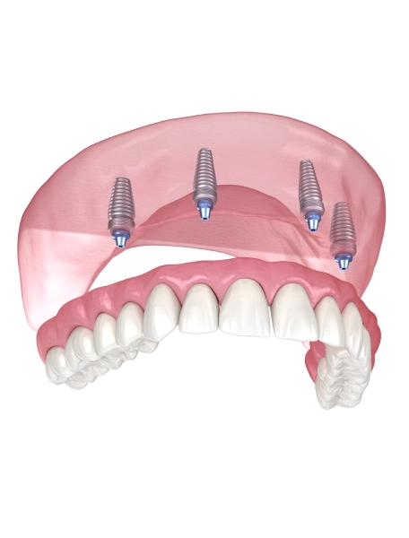 Types of Implant Supported Dentures​